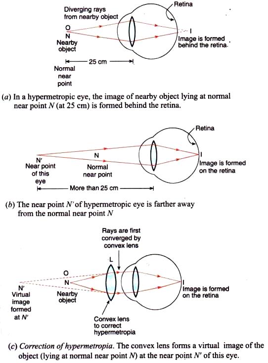 Lakhmir Singh Physics Class 10 Solutions Hypermetropia or long-sightedness